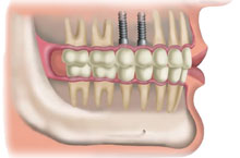 Implantes